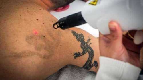 Iniciar un negocio de eliminación de tatuajes con láser